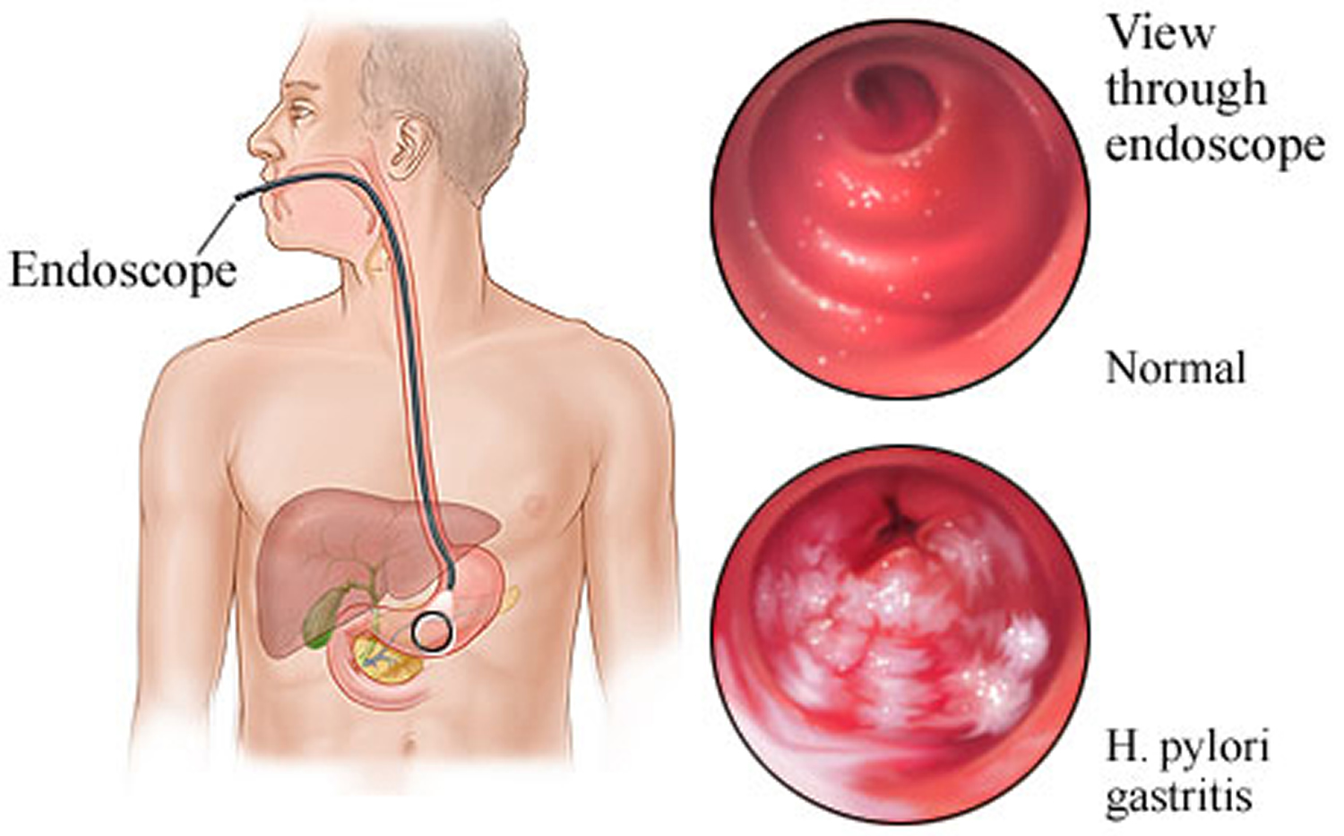 Поверхностный или катаральный гастрит: воспаление желудка и его лечение